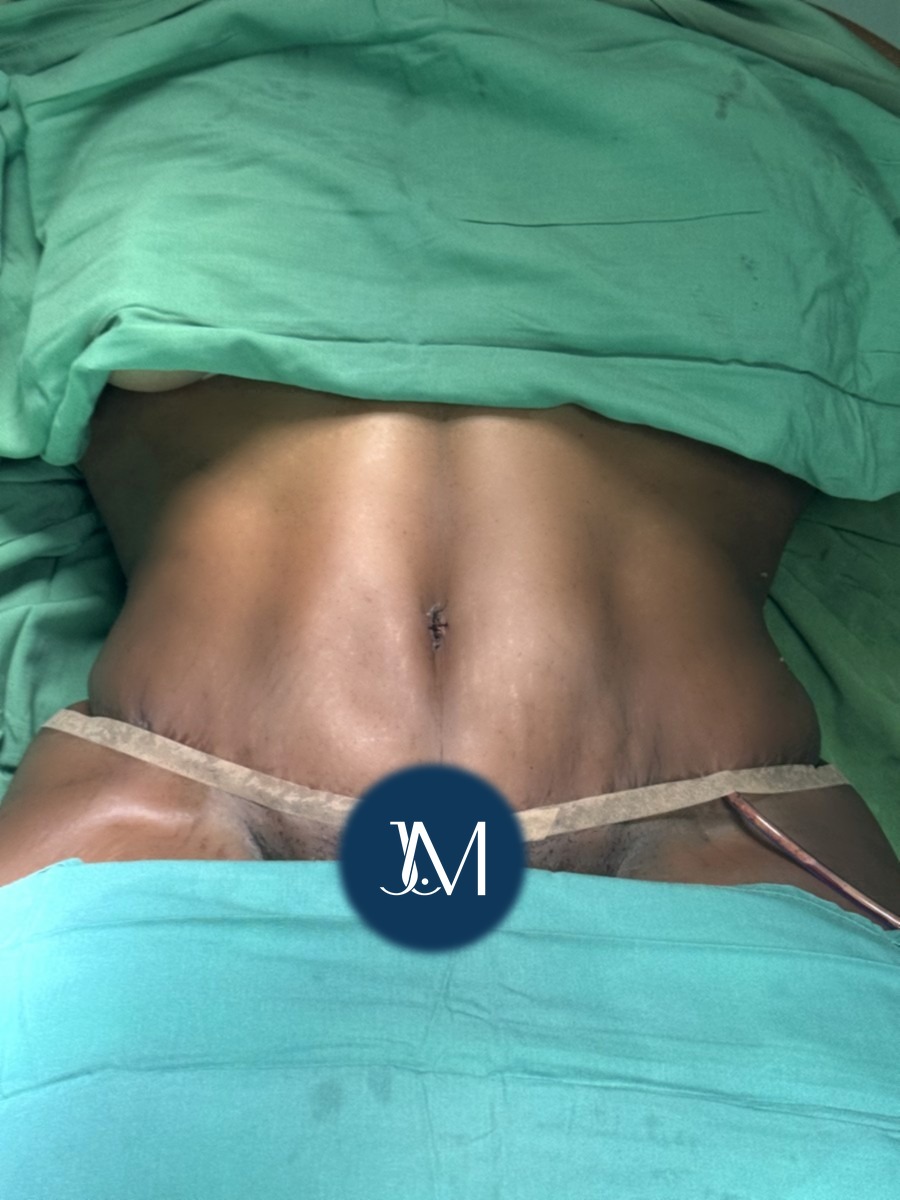 Abdominoplastia despu&eacute;s