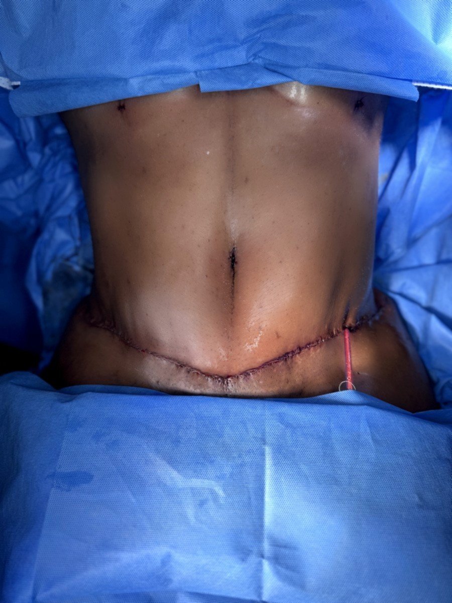 Abdominoplastia despu&eacute;s