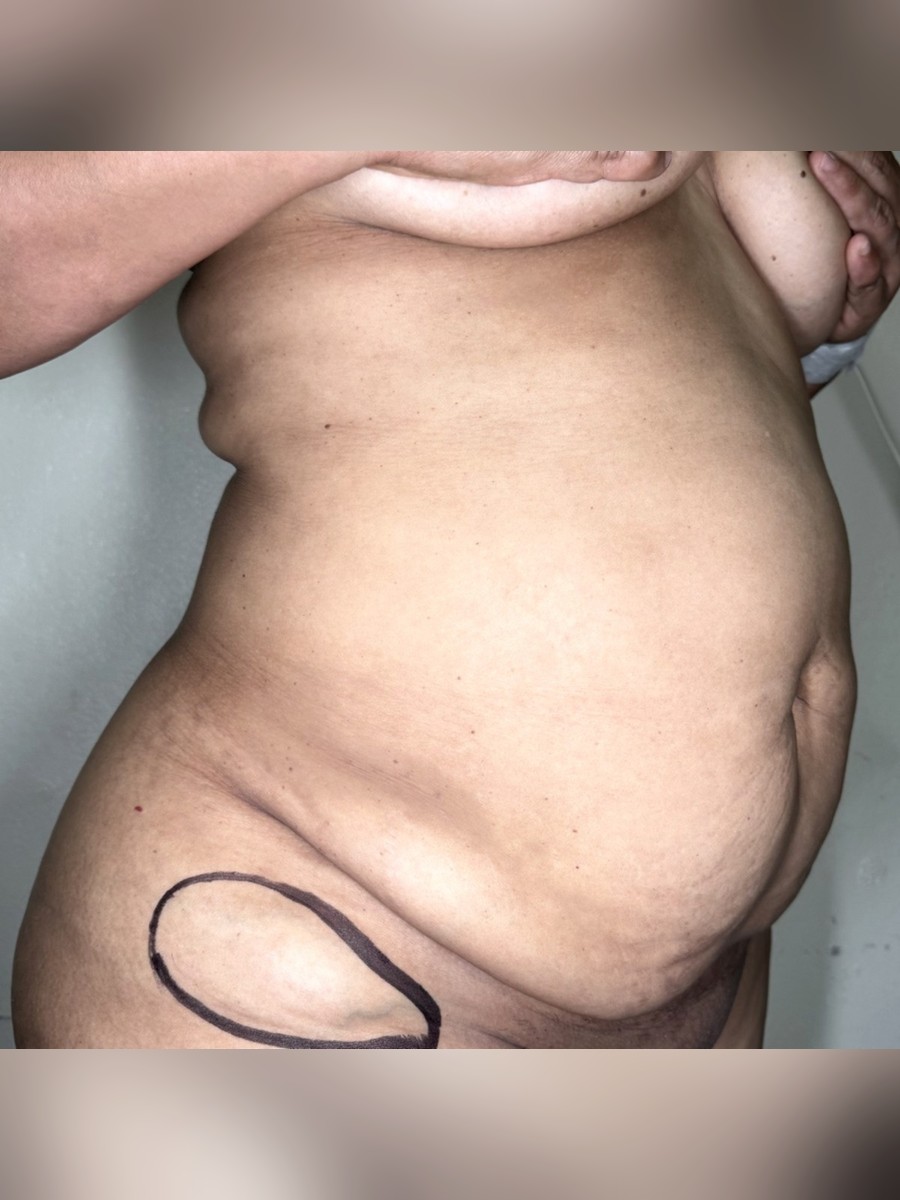 Abdominoplastia antes