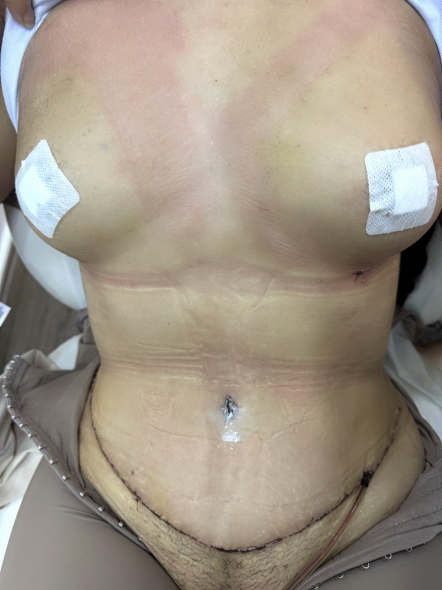 Abdominoplastia después