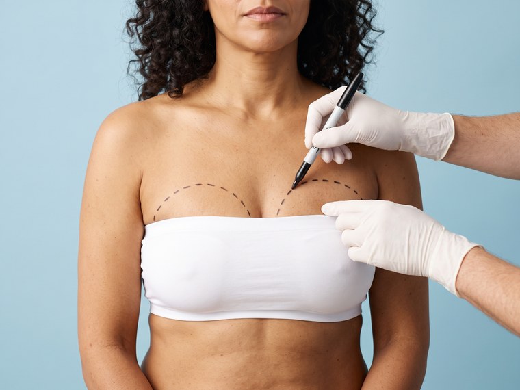 ¿Qué es la mamoplastia de reducción?